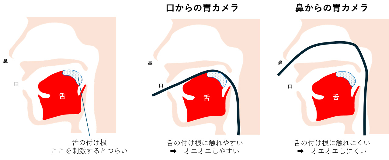 胃カメラ